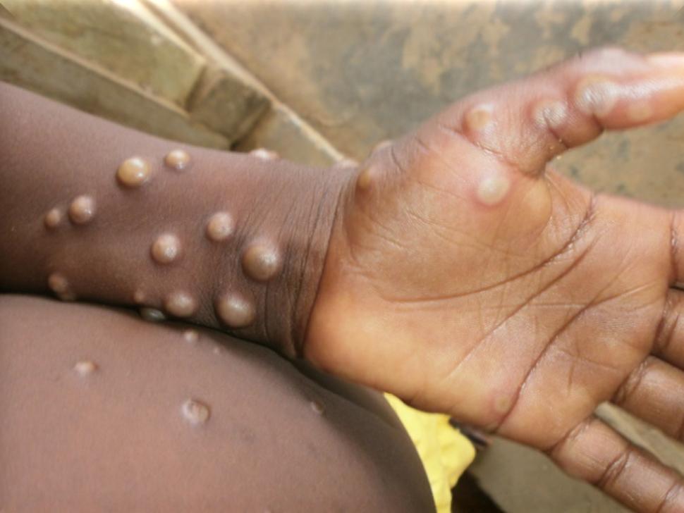 Clade I Mpox in Central and Eastern Africa – CDC
