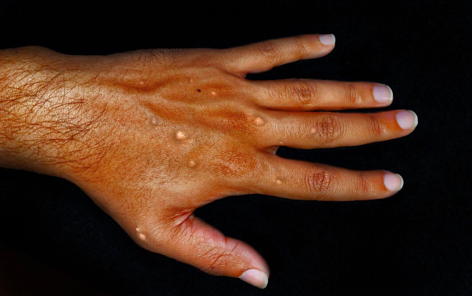 Mpox outbreaks declared in Kenya and Central African Republic. The race is on to contain the spread. – NBC News